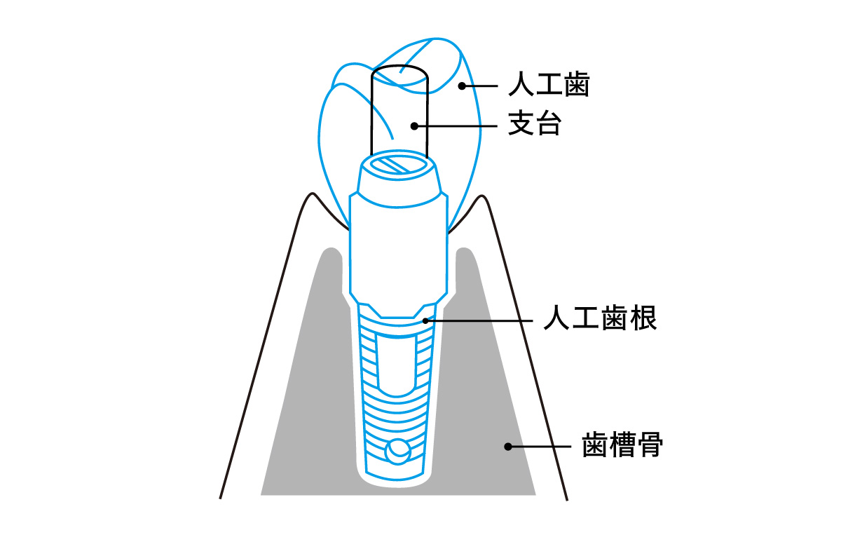 インプラントの構造