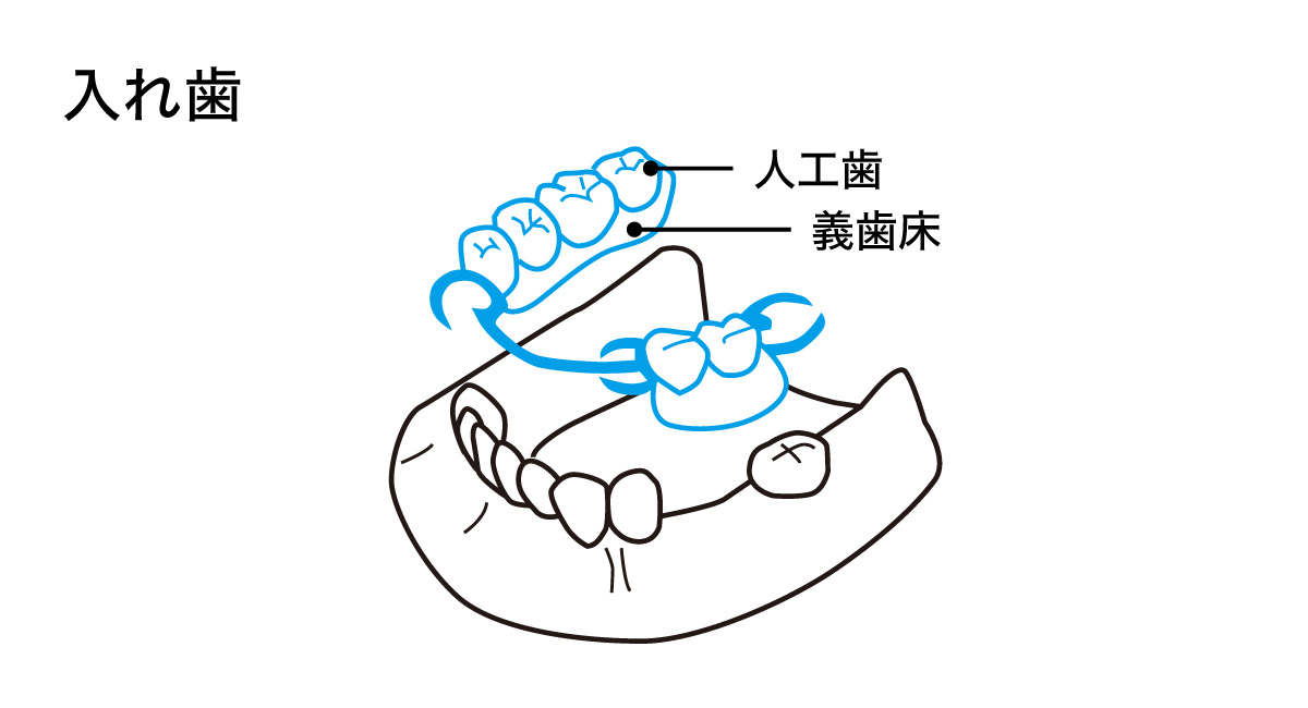 入れ歯の構造