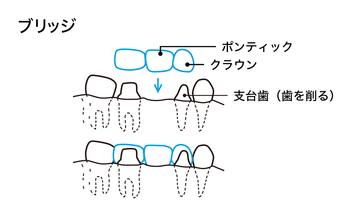 ブリッジの構造