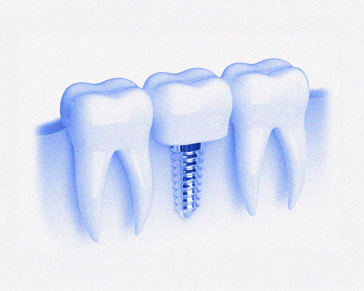 “第2の永久歯”インプラントとは？
