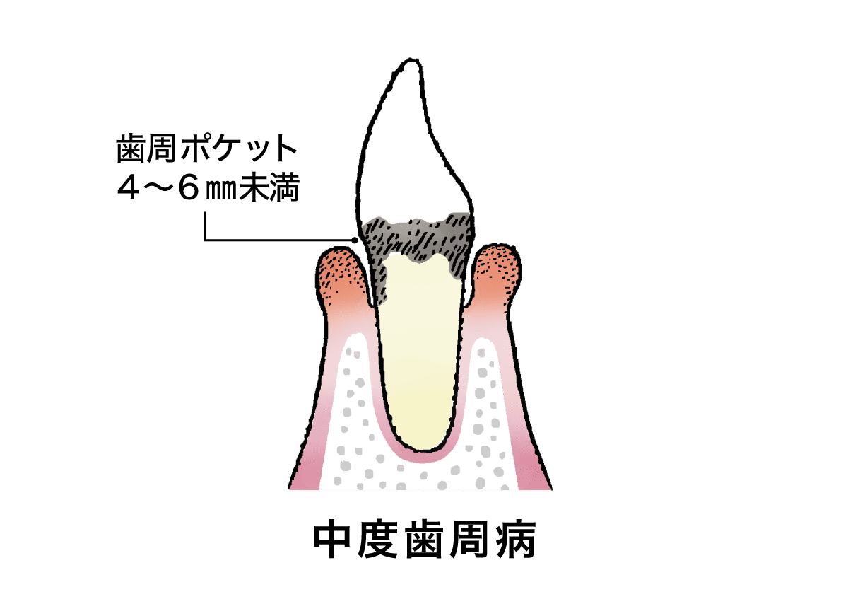 中度の歯周炎
