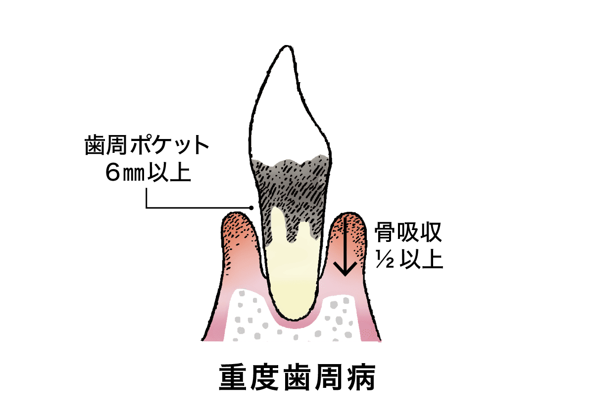 重度の歯周炎