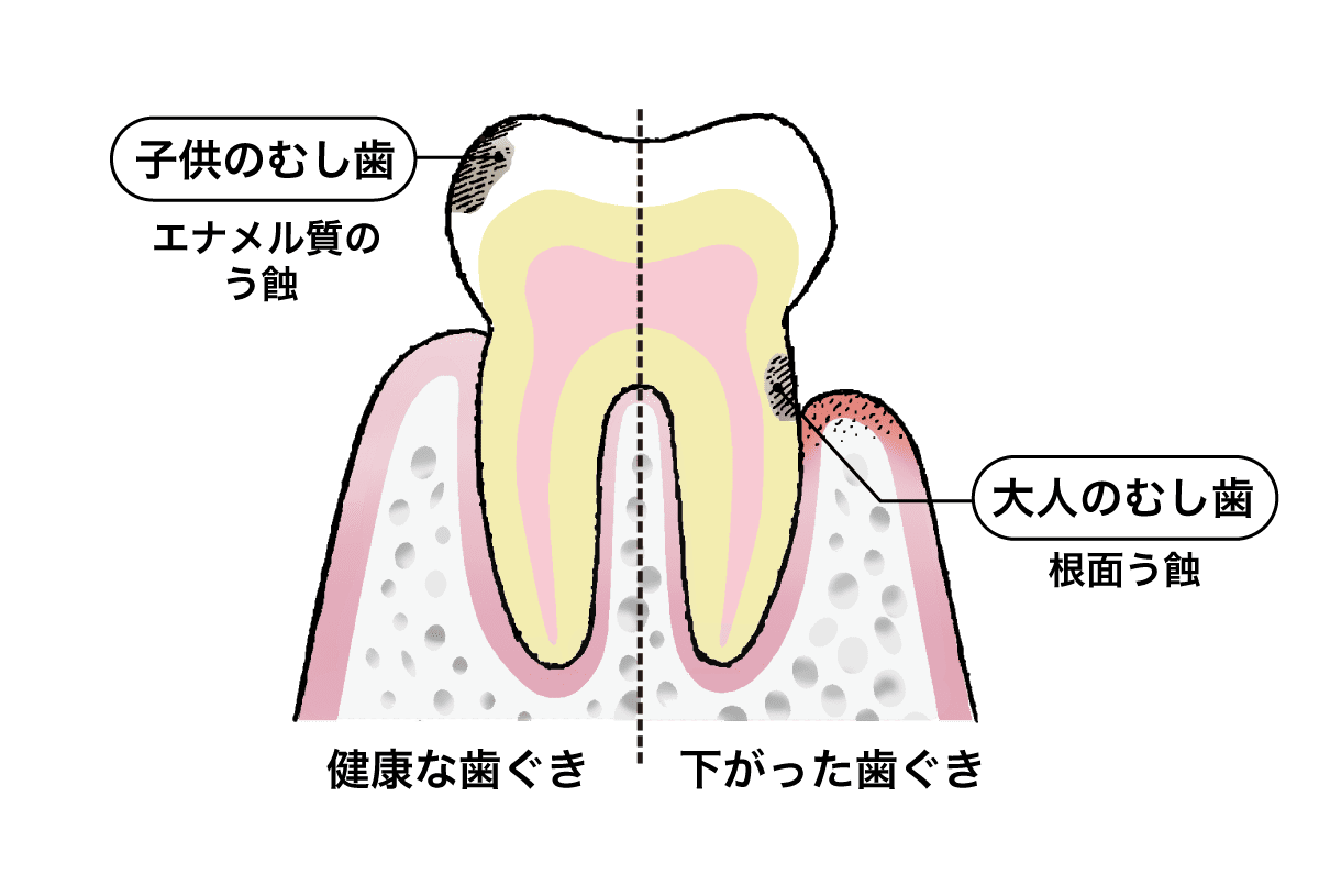大人の虫歯と子供の虫歯のイラスト