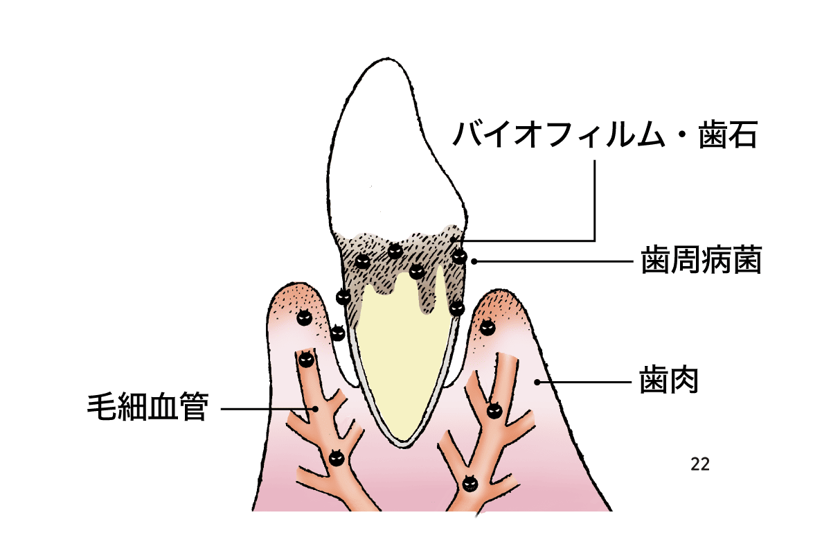 菌血症のイラスト