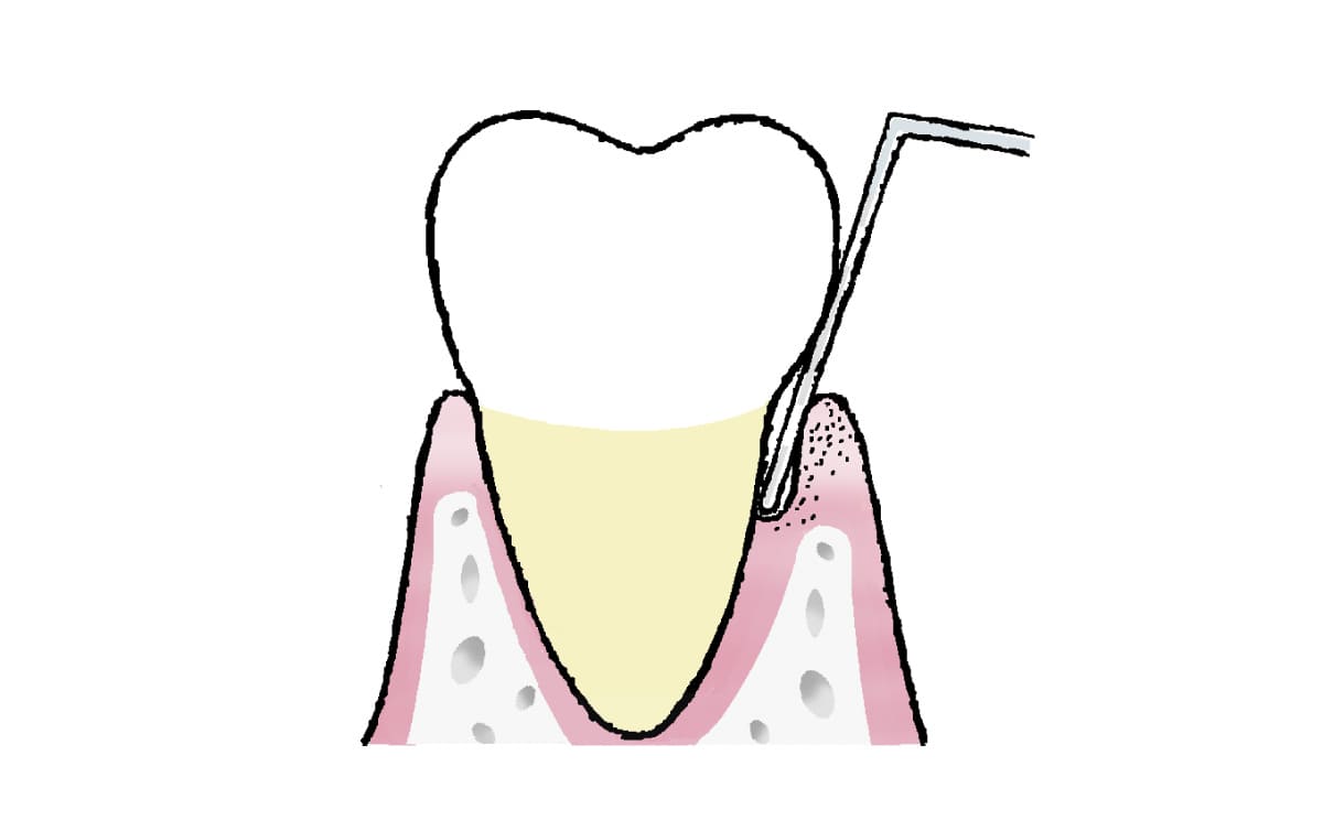 歯周ポケット検査イラスト