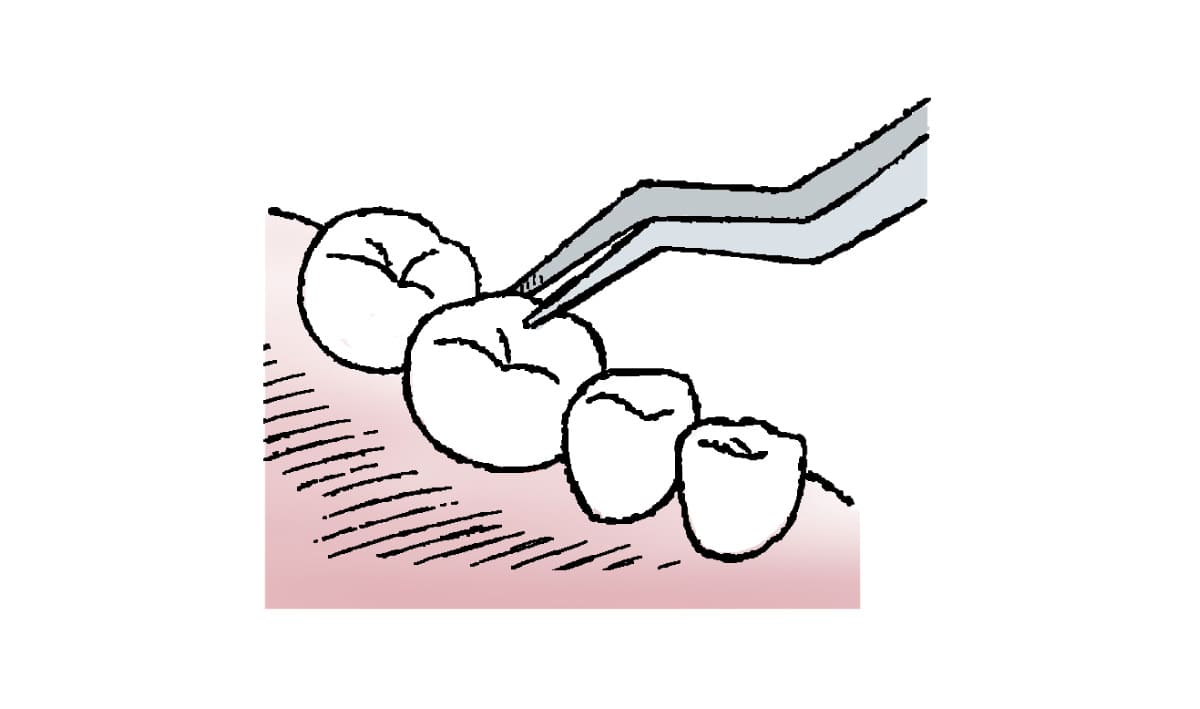 歯の動揺検査のイラスト