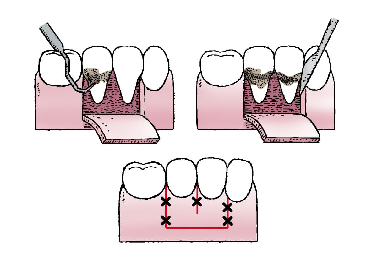 歯茎を切開して施術を行うイラスト