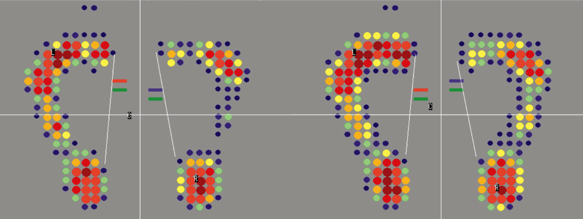 マウスガードの有無で、安定感に差