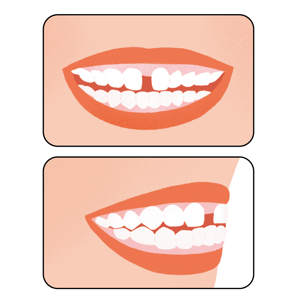 すきっ歯のイラスト