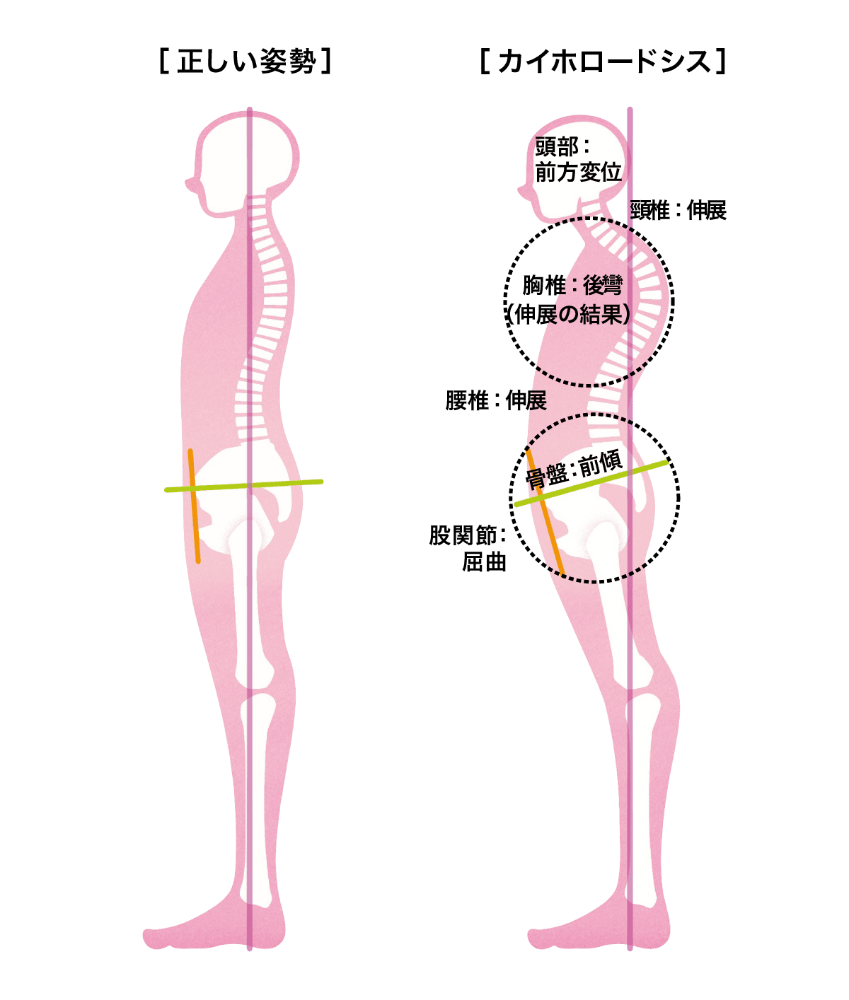 カイホロードシスの説明図