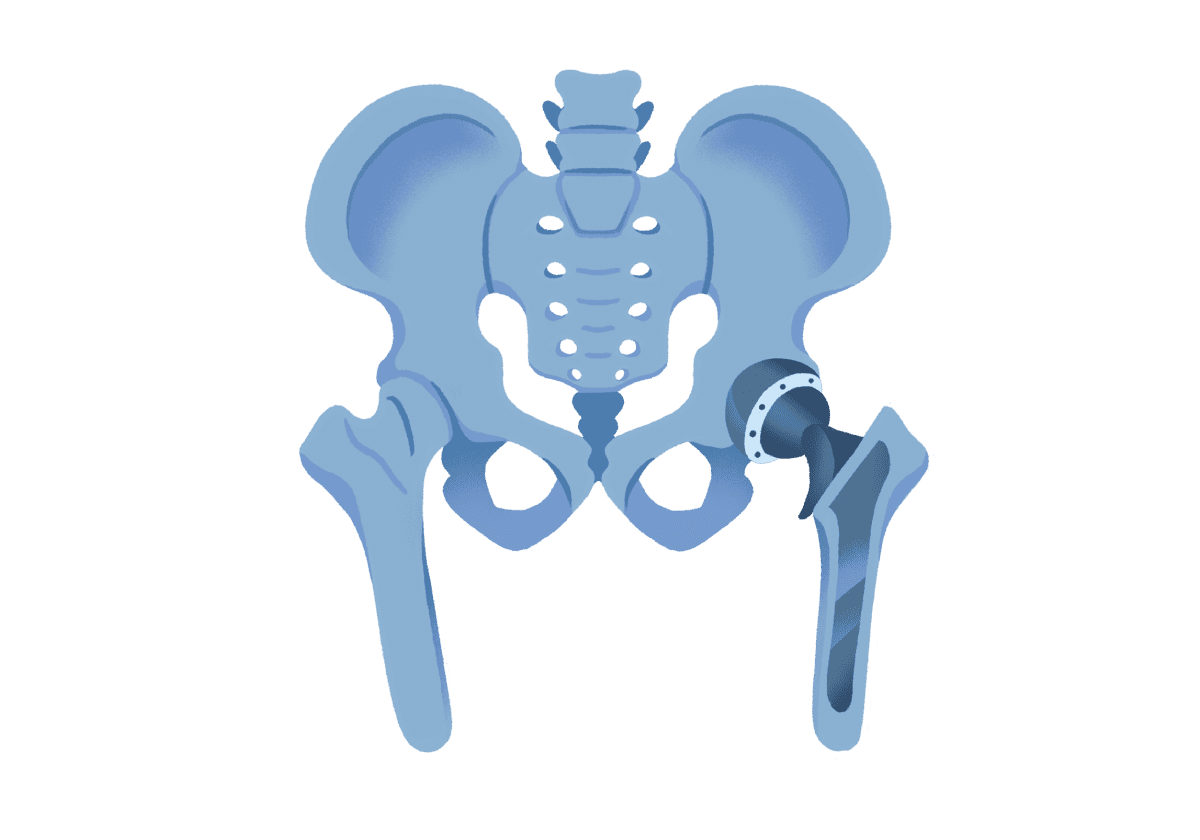 股関節に人工関節を置き換えたイラスト