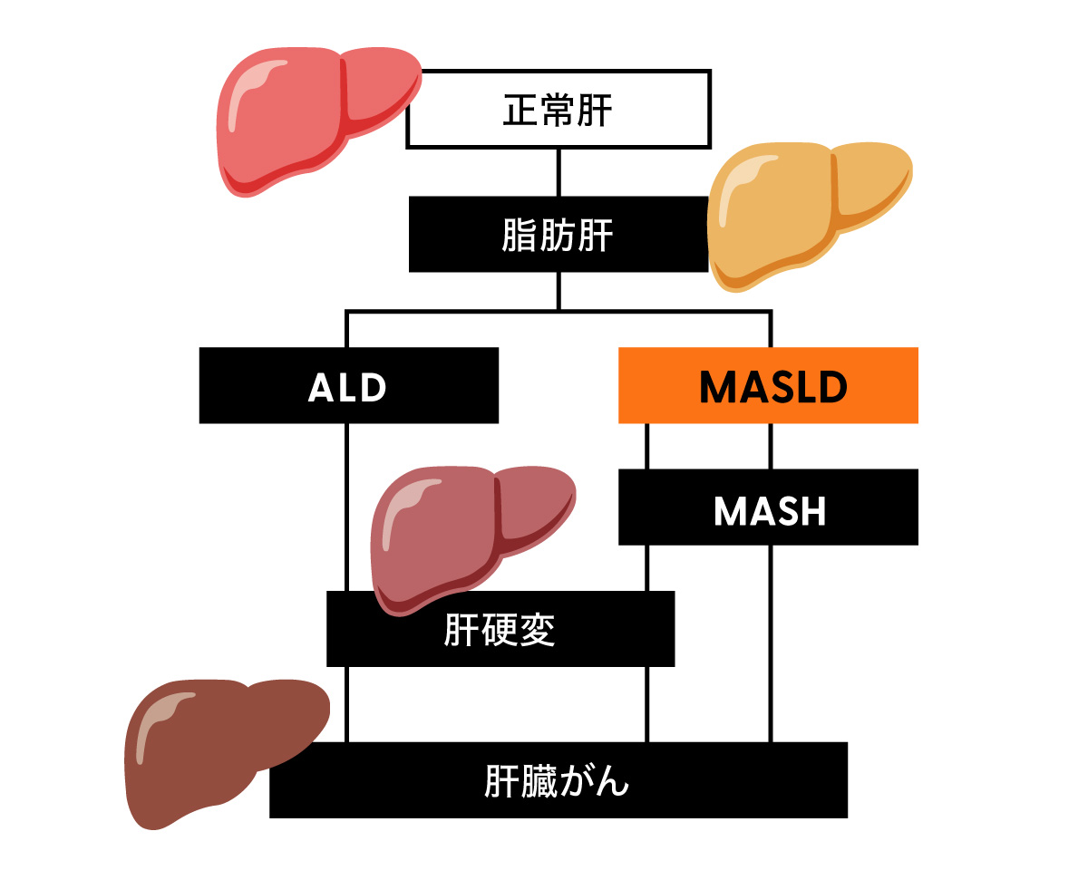 肝臓がんになるまでの図
