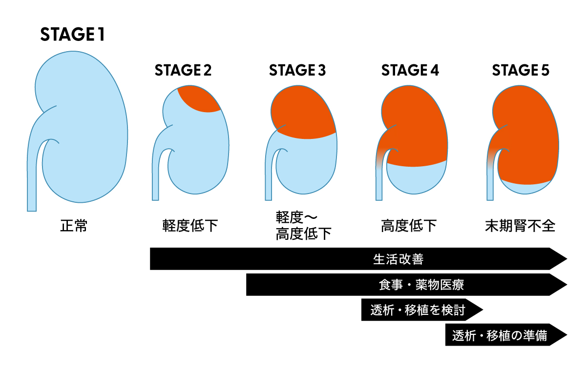 CDKに進行度と治療の目安