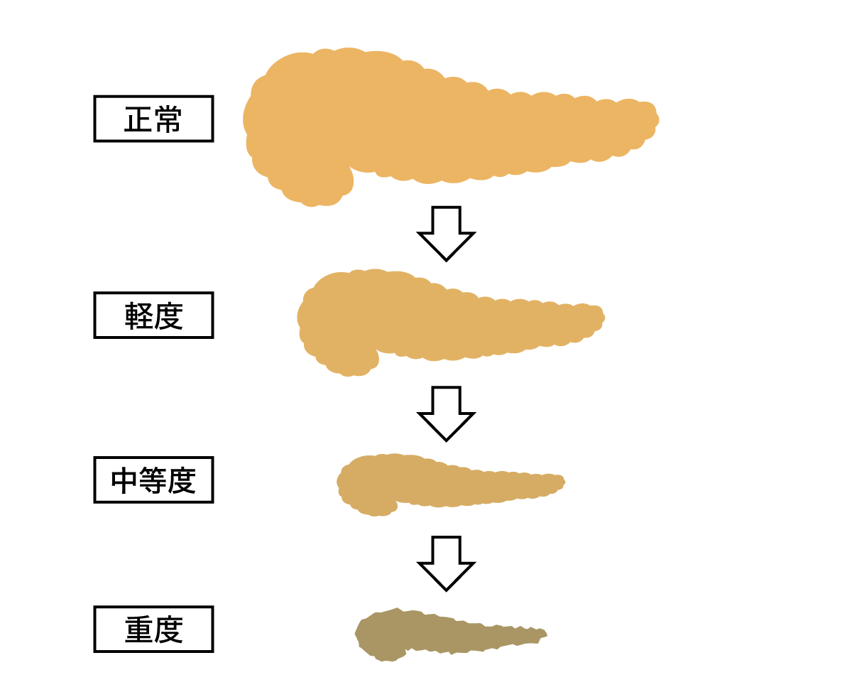 慢性膵炎の進行イメージ