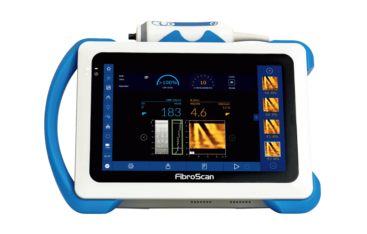 フィブロスキャン検査