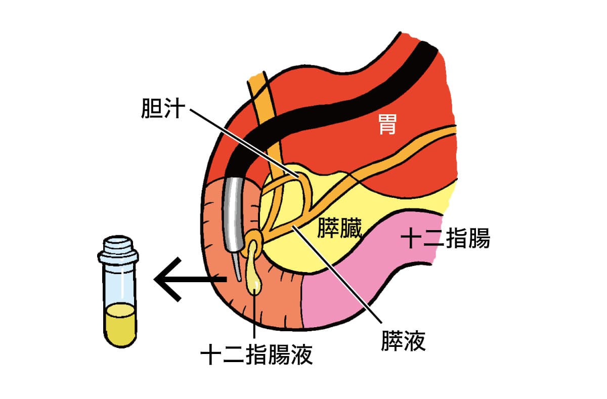 の内視鏡検査の際にカテーテルから十二指腸液を採取し、ここから膵がん細胞が産生する特定のタンパク質を解析しているイラスト