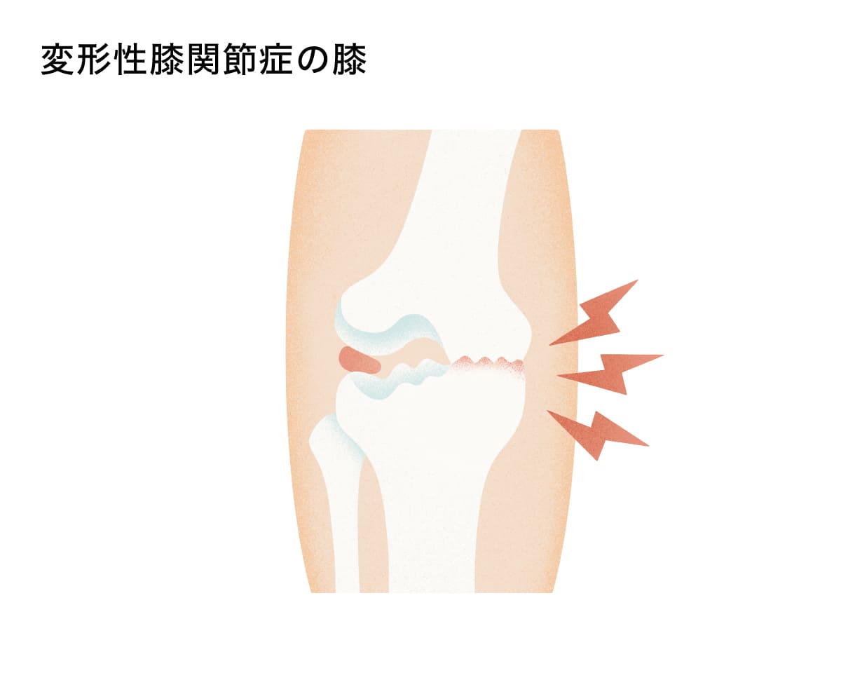 変形性膝関節症の膝