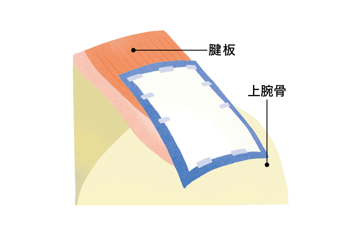 鏡視下腱板修復治療でI型コラーゲン繊維シートのイラスト