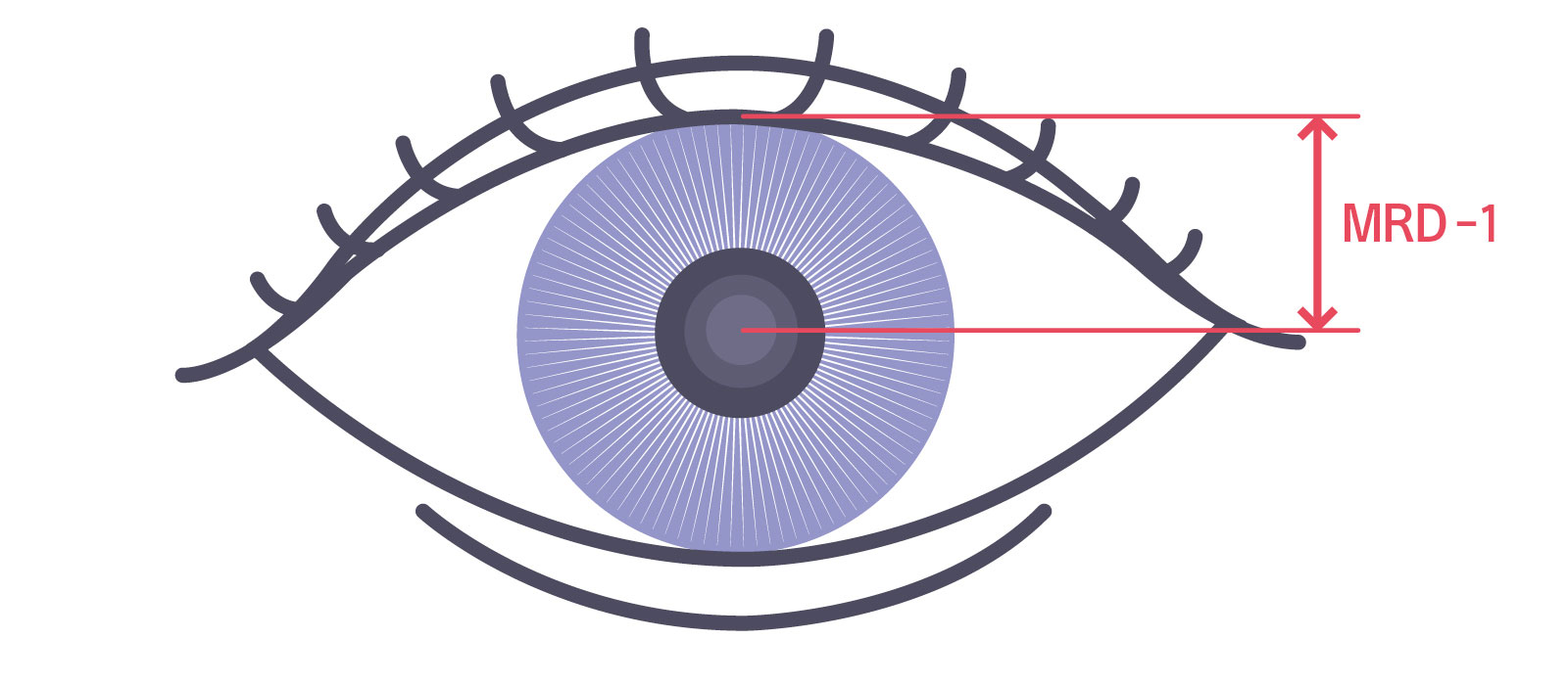 医療機関で眼瞼下垂の程度を診断する際に測定する数値 MRD-1（marginal reflex distance-1）