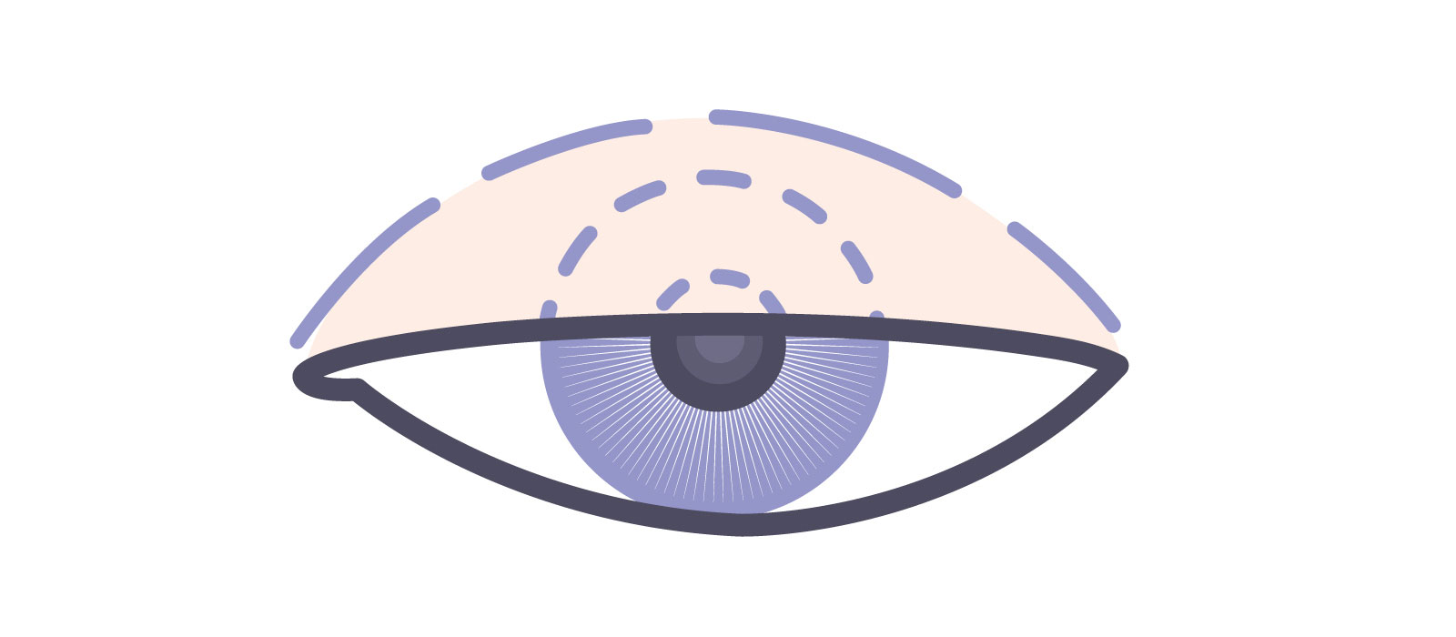 医療機関で眼瞼下垂の程度を診断する際に測定する数値 MRD-1（marginal reflex distance-1） イラスト