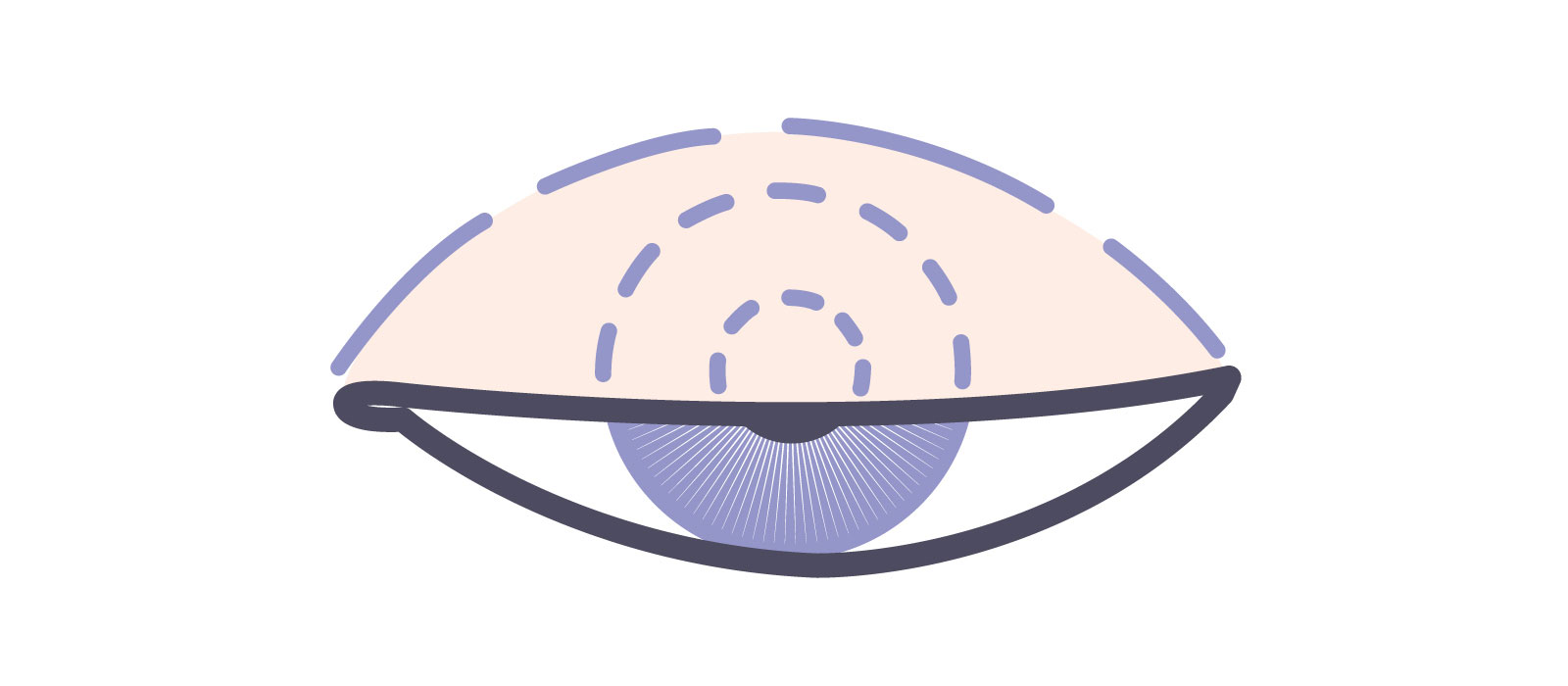 医療機関で眼瞼下垂の程度を診断する際に測定する数値 MRD-1（marginal reflex distance-1） イラスト